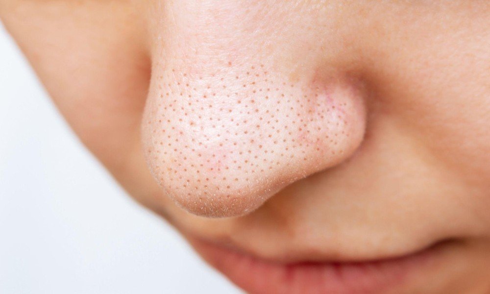 3 Reasons Why Some Laser Treatments Shrink Cheek Pores but Not Nose Pores